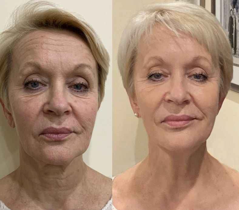 Face Yoga Kuur - Verstevig en Verjong Je Gezicht!
